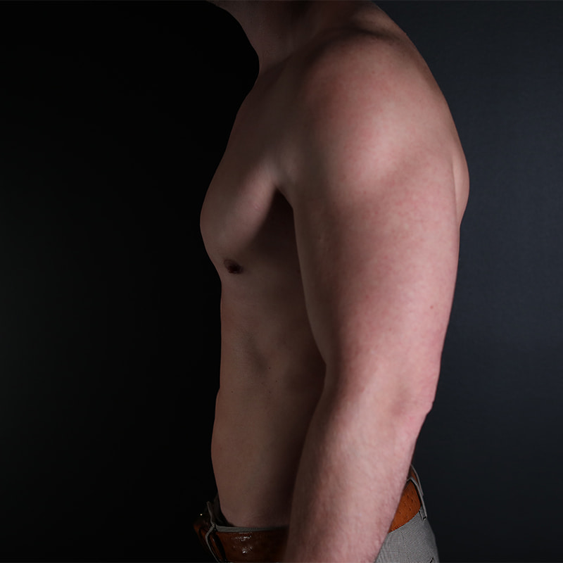 Gynecomastia Before & After Image