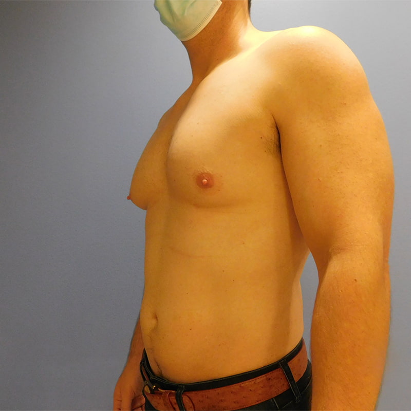 Gynecomastia Before & After Image