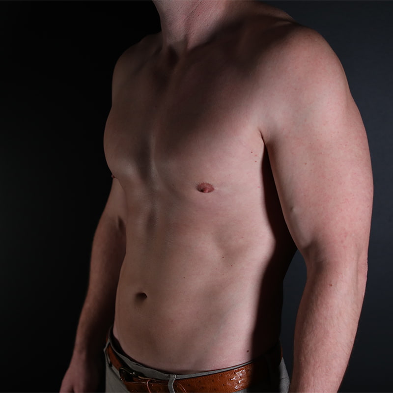 Gynecomastia Before & After Image