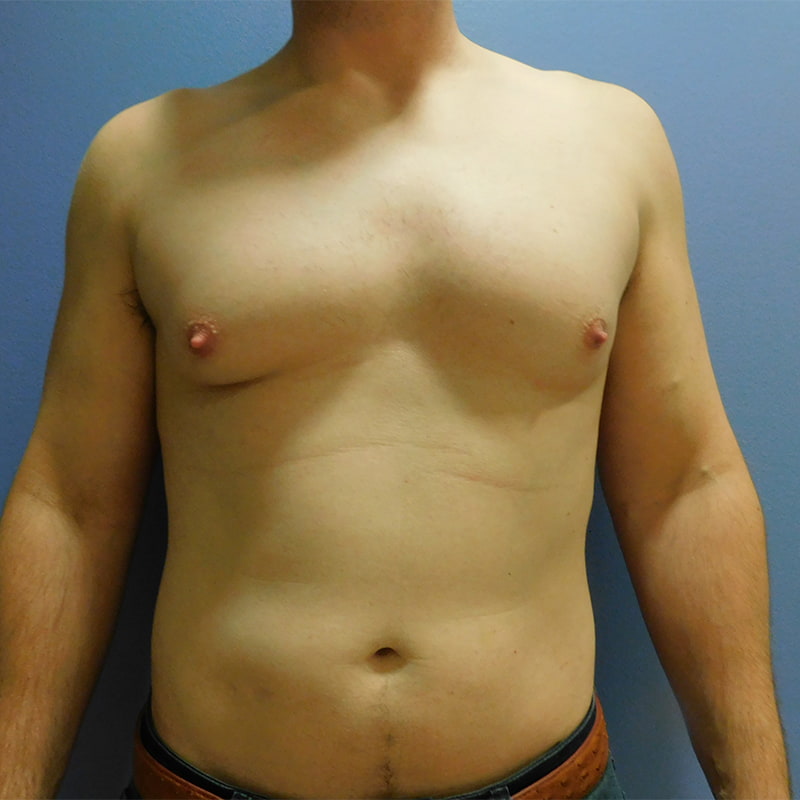 Gynecomastia Before & After Image