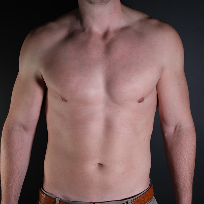 Gynecomastia Before & After Image