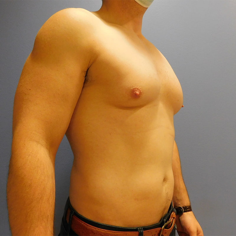 Gynecomastia Before & After Image