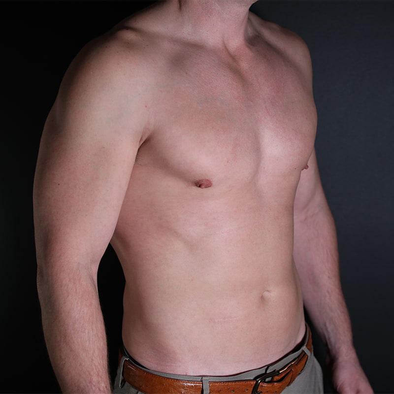 Gynecomastia Before & After Image