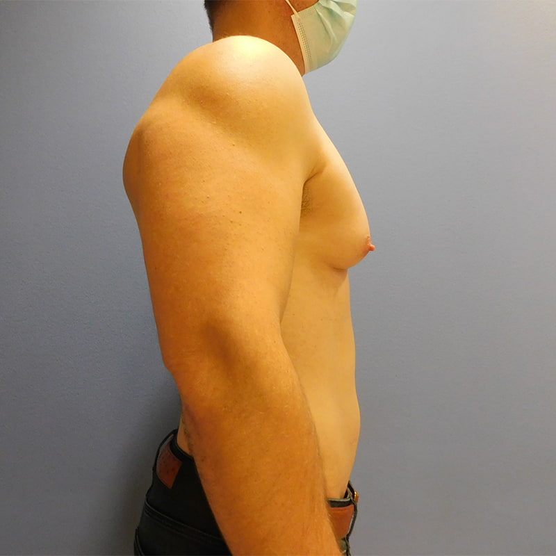 Gynecomastia Before & After Image