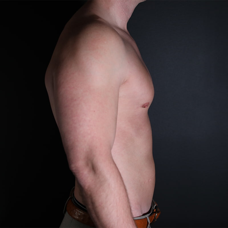 Gynecomastia Before & After Image