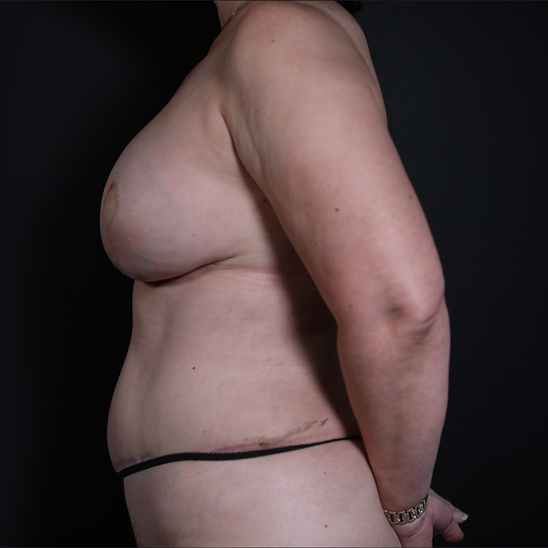 Breast Reconstruction Before & After Image