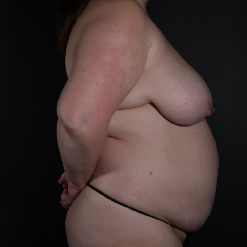 Breast Reconstruction Before & After Image