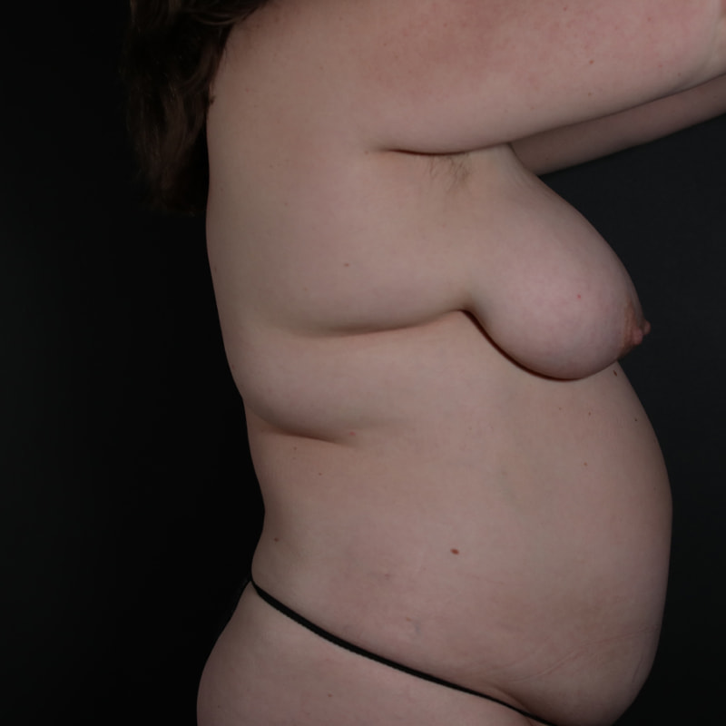 Breast Reconstruction Before & After Image