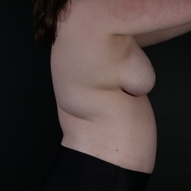 Breast Reconstruction Before & After Image