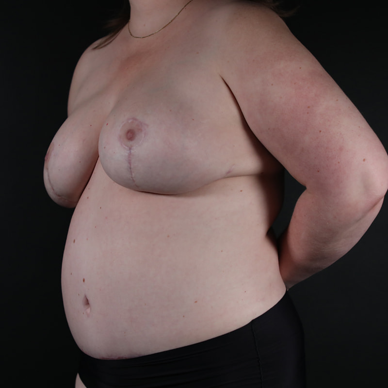 Breast Reconstruction Before & After Image