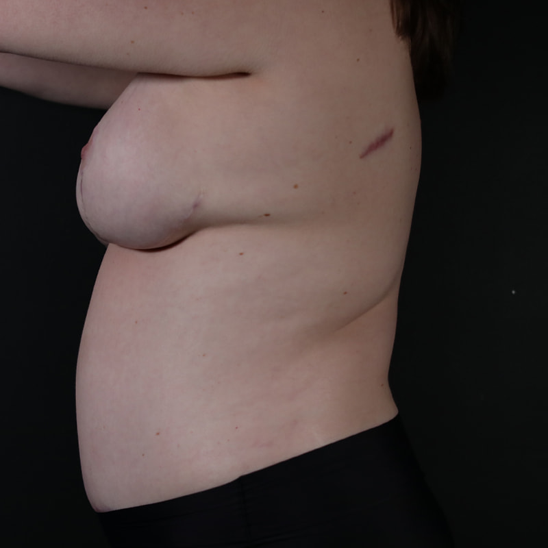 Breast Reconstruction Before & After Image