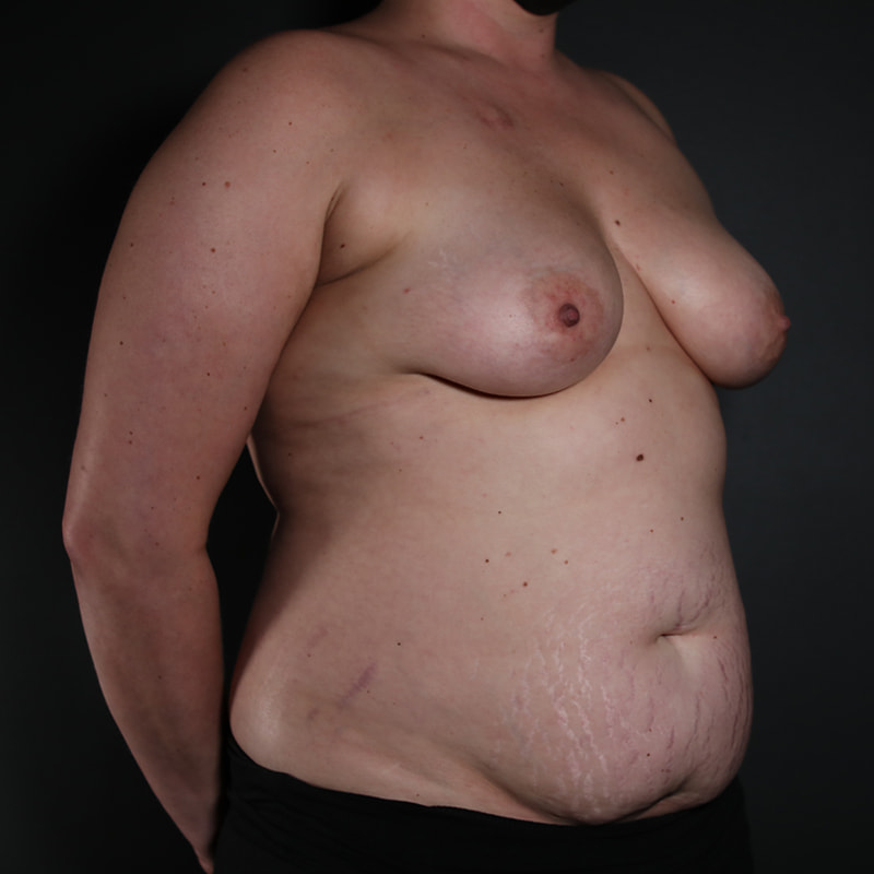 Breast Reconstruction Before & After Image