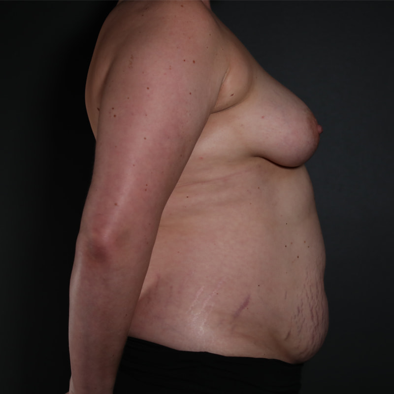 Breast Reconstruction Before & After Image