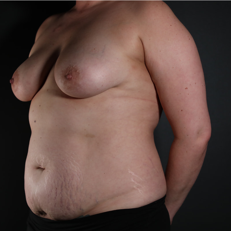 Breast Reconstruction Before & After Image