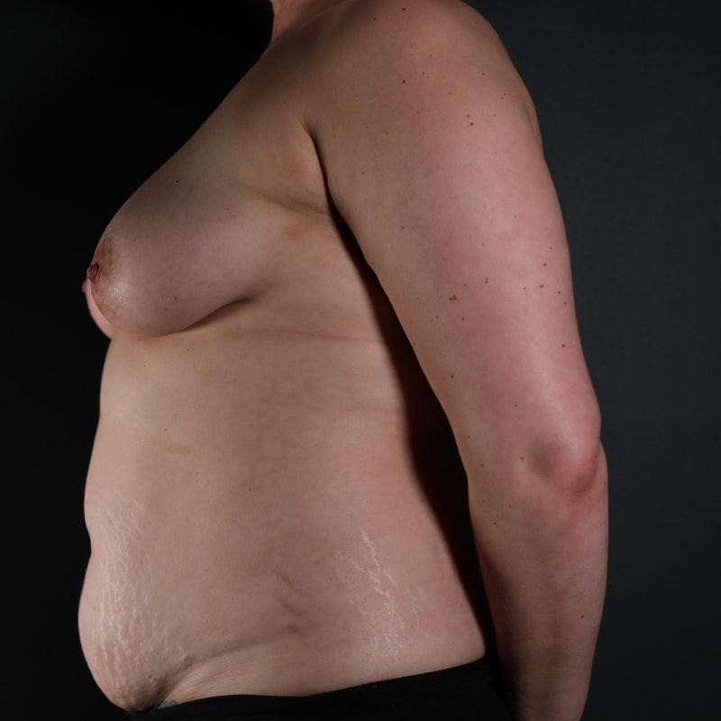 Breast Reconstruction Before & After Image